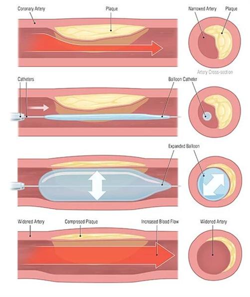 When Is Stent Needed In Heart