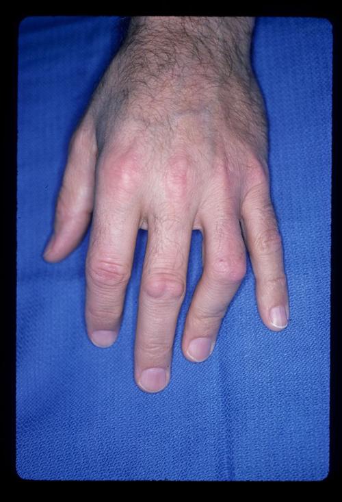 指节垫 治疗图片