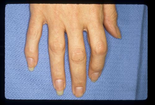 指节垫 治疗图片