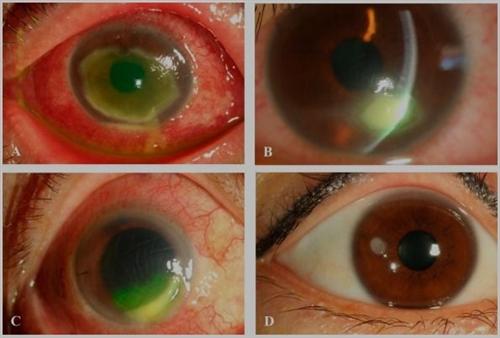 流行性角膜结膜炎