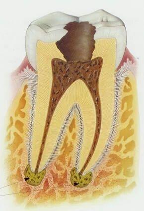 牙髓组织红蓝铅笔图图片