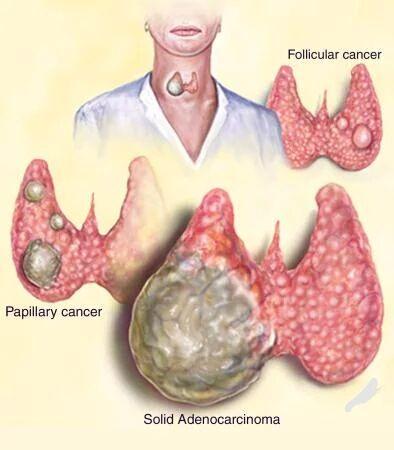 甲状腺癌照片图片