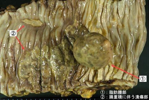 肠道脂肪瘤图片