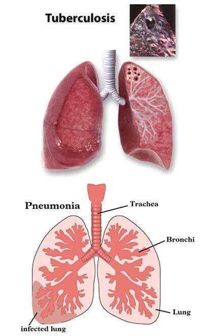 肺结核照片图解图片