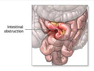 绞榨性肠梗阻图片