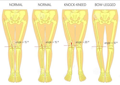 膝内翻有什么症状