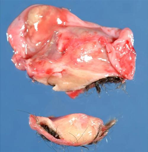 卵巢未成熟畸胎瘤图片
