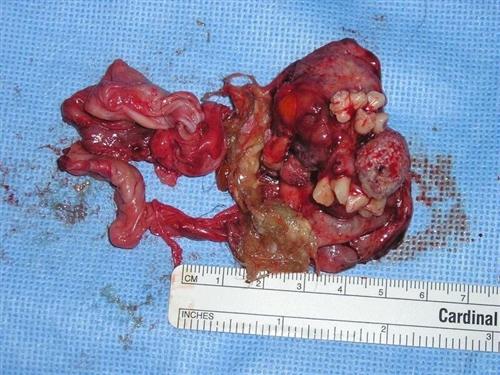畸胎瘤图片恶性图片
