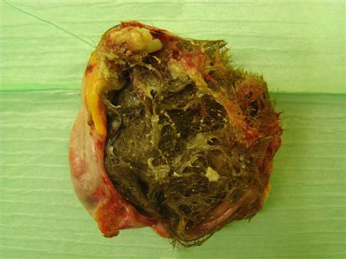 卵巢未成熟畸胎瘤图片