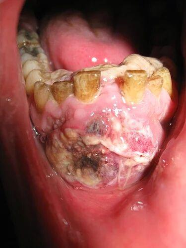 上颚口腔癌图片图片