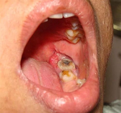 口腔肿瘤照片图片