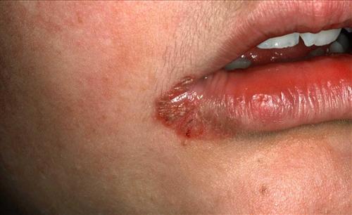 唇炎几种症状图片图片