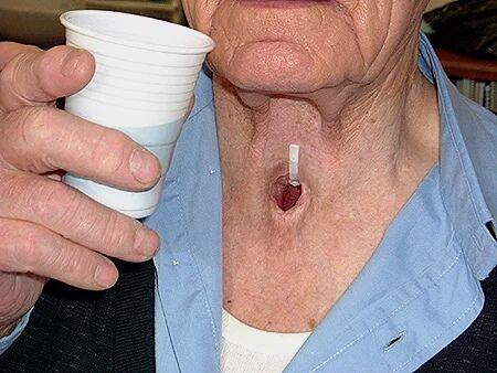 喉癌是什么症状图片图片