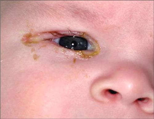 婴儿结膜炎结眼屎图片图片