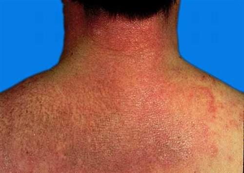 无肌病性皮肌炎