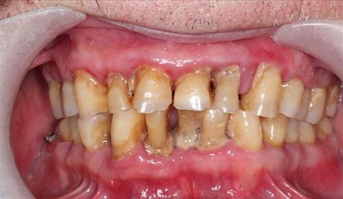 牙周病晚期图片图片