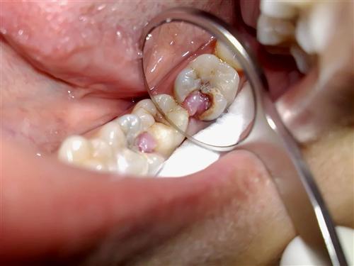 慢性增生性牙髓炎图片