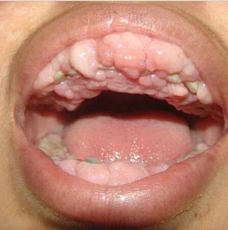 牙龈赘生物图片图片