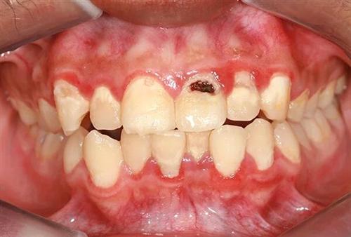 孩子牙瘤图片图片