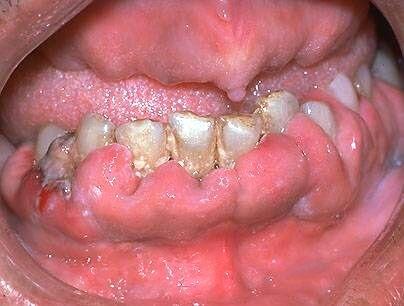 牙瘤钙化图片