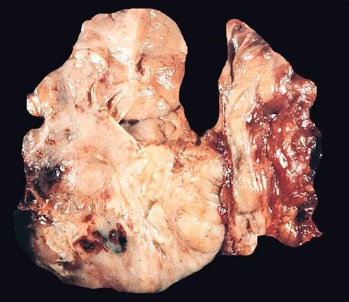 甲状腺肿瘤照片图片