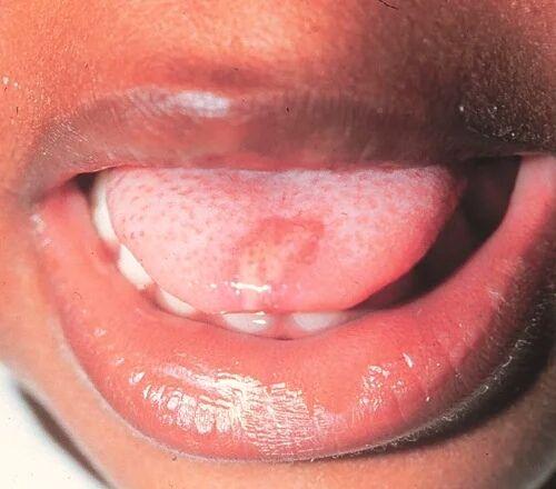 疱疹性咽峡炎中期图片图片