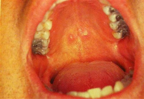 成人疱疹性咽峡炎症状图片