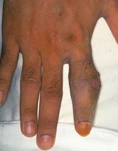 瘰疬性皮肤结核病