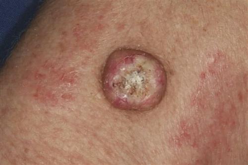 浅表性皮肤癌图片