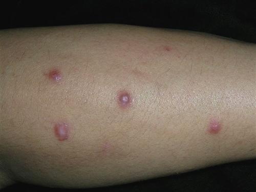 结节性痒疹的症状图片