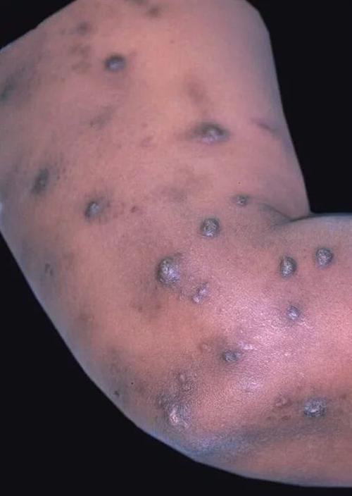 结节性痒疹五个阶段图片
