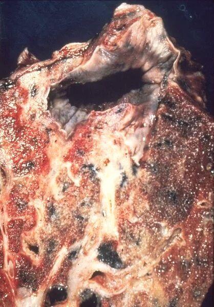 血行播散肺结核图片图片