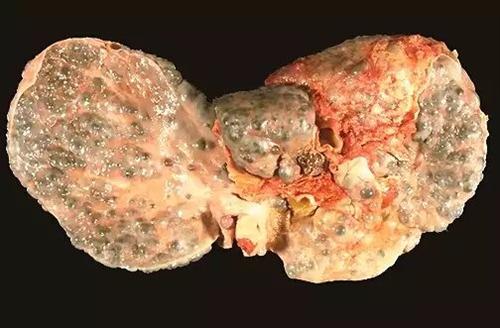 肝硬化晚期的肝的图片图片