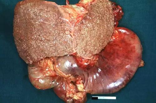 门脉性肝硬化大体标本图片