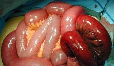 肠梗阻症状图片图片