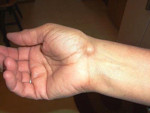 手指腱鞘囊肿症状图片图片