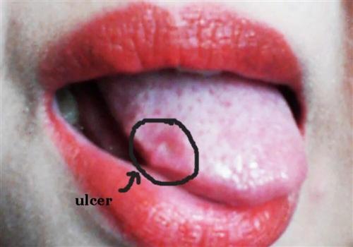 舌头两侧溃疡图片