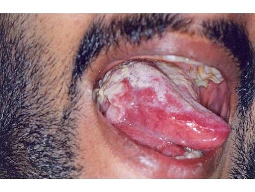 舌头溃疡的症状图片图片