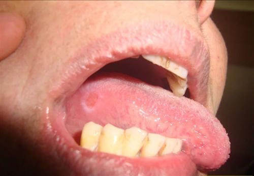 舌头溃疡真实图图片
