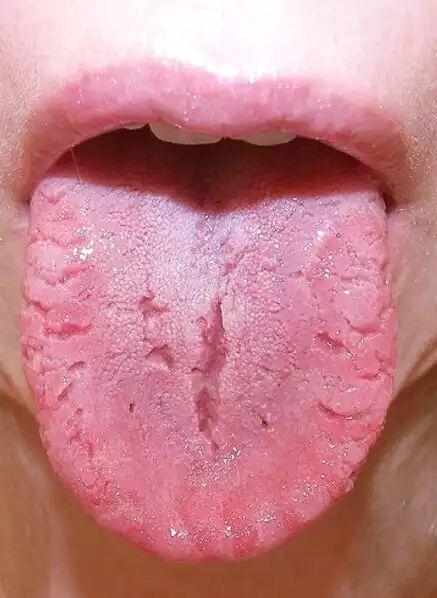 天生裂纹舌图片图片