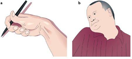 肌张力障碍综合征