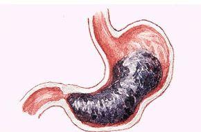 胃十二指肠溃疡瘢痕性幽门梗阻