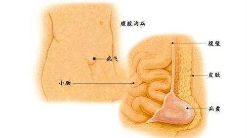 腹股沟在什么位置图图片