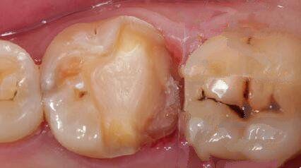慢性增生性牙髓炎图片
