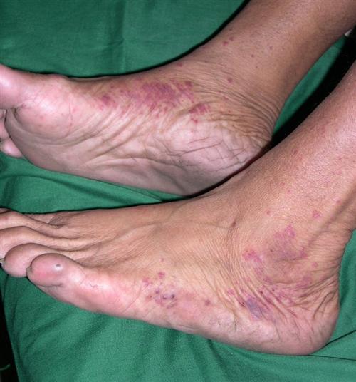 显微镜下多血管炎