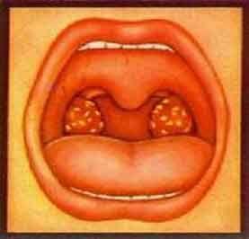 化脓性扁桃体炎