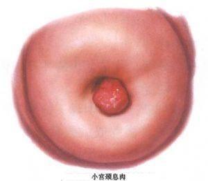 宫颈息肉示意图图片