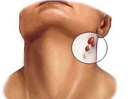 颈部淋巴瘤位置图片