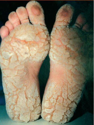 变异性红斑角化病