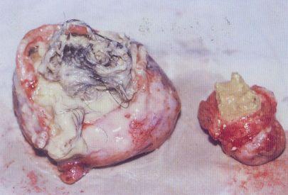 眼眶畸胎瘤图片